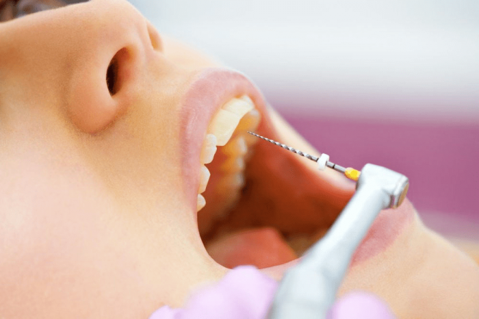 Root Canal Treatment Will Improve Your Health