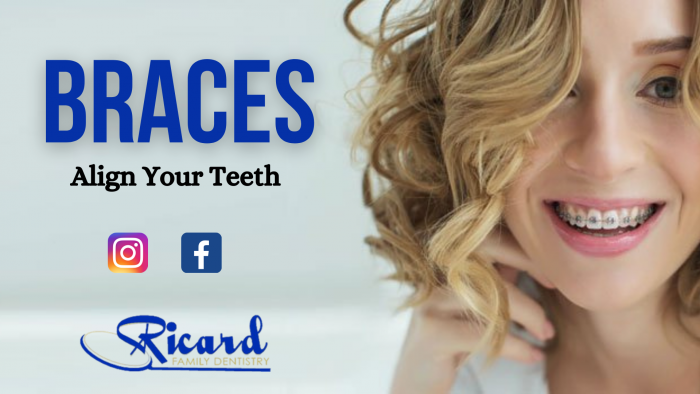 Solutions to Teeth Alignment Problems