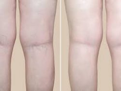 After sclerotherapy for varicose or spider veins