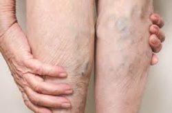 How to Cover Spider Veins on Legs?