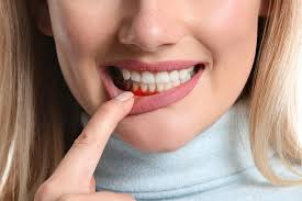 Tooth Abscesses Symptoms and Causes Dentist In Houston, TX