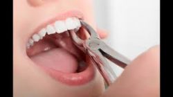 Tooth Extraction at URBN Dental 