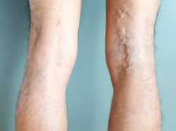 Varicose Vein Removal Side Effects