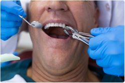 What Is Dental Extraction?