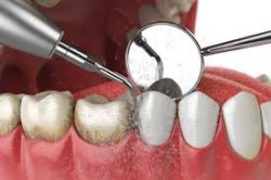What Is Periodontal Maintenance?