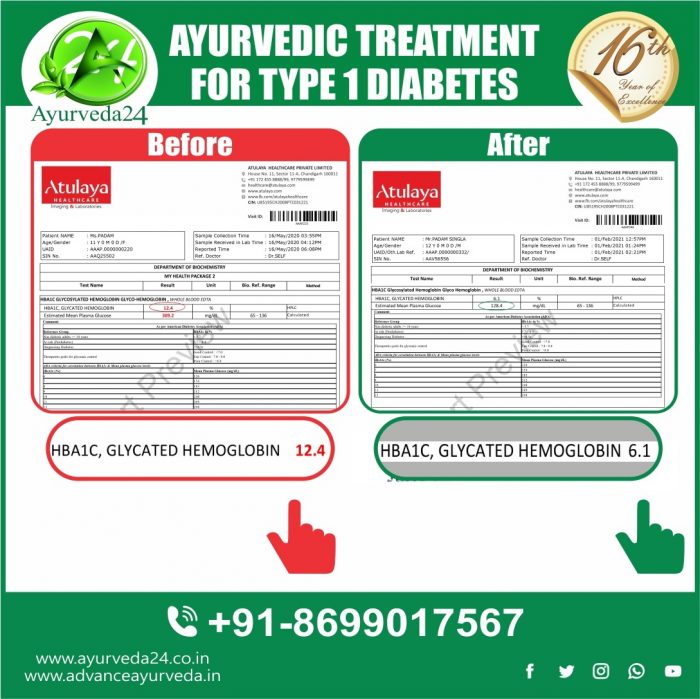 Type 1 Diabetes Treatment In Ayurveda