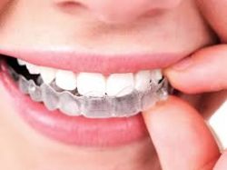 ABOUT INVISALIGN NEAR ME