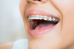 WHAT IS ACCELERATED ORTHODONTICS?