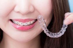 Get A Beautiful Smile With The Best Invisible Braces