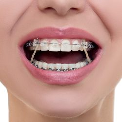 FINDING THE BEST ORTHODONTIST FOR BRACES