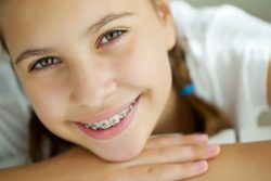 HOW MUCH DO BRACES COST FOR CHILDREN?