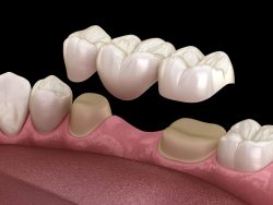 Replacing Crowns and Getting Teeth Whitened | Dentist Uptown Houston