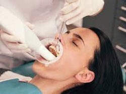 Dental Teeth Cleaning Houston