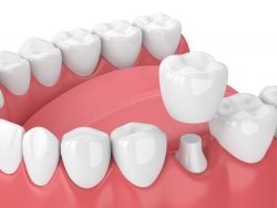 Do I Need A Porcelain Crown Near Me | Porcelain Dental Crowns Costs