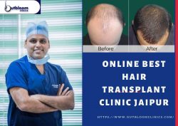 Hair transplant cost in India at Outbloom Clinics