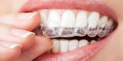 One of The Best Invisalign Dentist In Houston