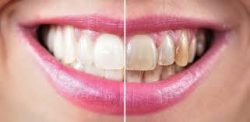 What is Tooth Whitening?