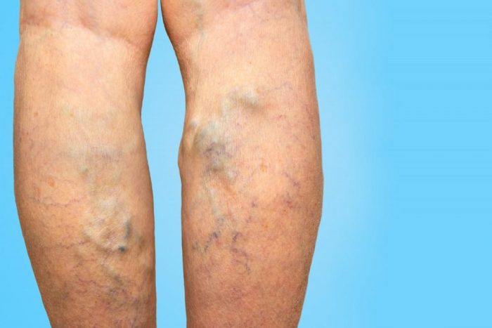 What Can I Expect from Spider Vein Treatment in TX?