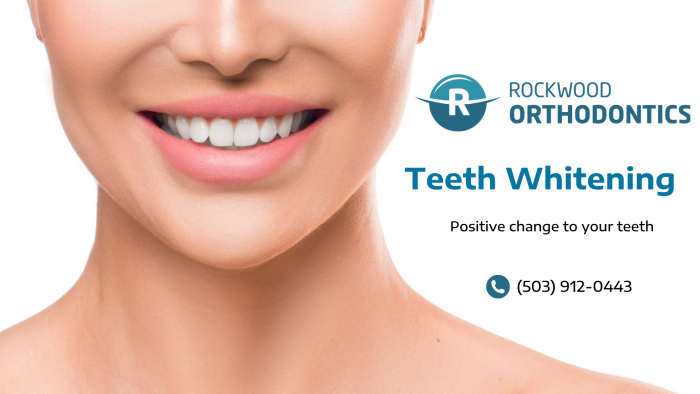 Whitening Solutions for a Sparkling Smile