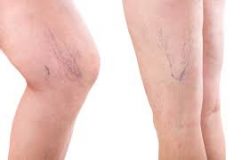 6 Steps to Better Legs When You Receive Spider Vein Treatment in Texas
