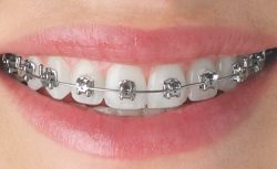 How To Find An Orthodontist Near Me?