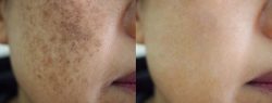 Best Dark Spot Removal Treatment – Erasing Damage And Scars