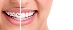 How To Find The Best Orthodontics In Aventura, Fl?