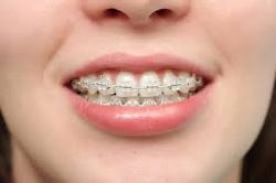 How To Find Orthodontic Treatment In Aventura, Fl?