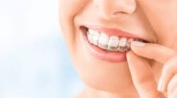 Aventura Teeth Braces Cost
