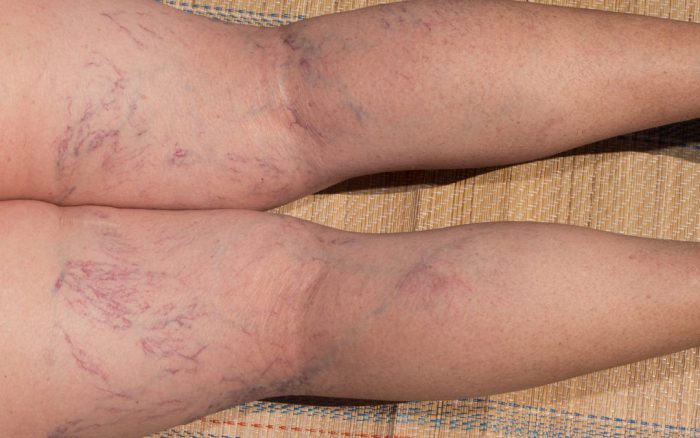 Spider Veins are Clinic in the Near Me
