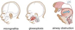 All You Need to Know About Micrognathia or Small Jaw