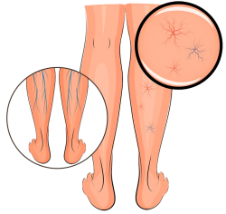 Varicose Vein are Clinic in the Near Me