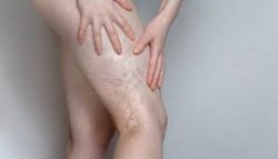 How we treat varicose veins and underlying venous insufficiency.