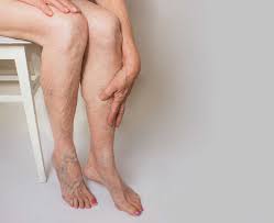 What are the causes of spider and varicose veins?