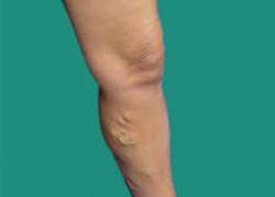 Why do vein experts recommend a minimally invasive procedure to treat varicose veins?