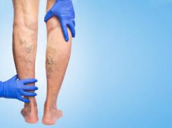 The best vein clinics screen for vein disease before curating a varicose vein treatment plan.