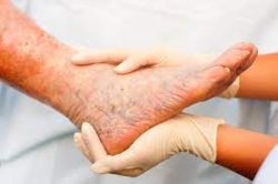 Vein specialists may recommend minimally invasive treatments to remove superficial veins, includ ...