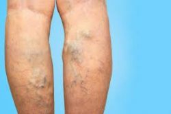 Diagnose the root cause of your spider veins and varicose veins.