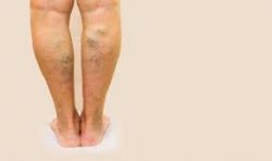 What are the symptoms of spider veins?
