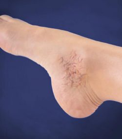 A COMPREHENSIVE GUIDE TO VARICOSE VEIN TREATMENT IN SUFFOLK COUNTY