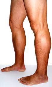 What are the Signs and Symptoms of Chronic Venous Insufficiency?