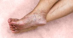 How can I find the best spider vein treatment clinic near me in Suffolk County?