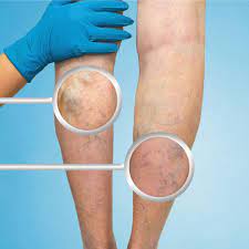 What’s venous disease? And how does it lead to varicose veins and spider veins?