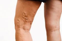 What does varicose vein treatment cost?