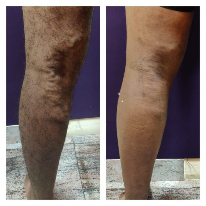 Does insurance pay for varicose vein treatment?