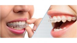 AVERAGE COST OF INVISALIGN And BRACES