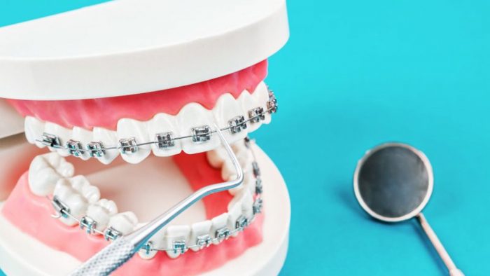 THE BEST AGE FOR BRACES