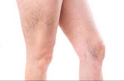 Best Spider Veins Treatment in Houston, Texas (Sclerotherapy)