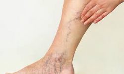 The Long Island vein specialists curate a minimally invasive vein therapy plan.