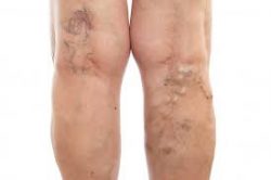 Importance of Treating Varicose Veins and Spider Veins